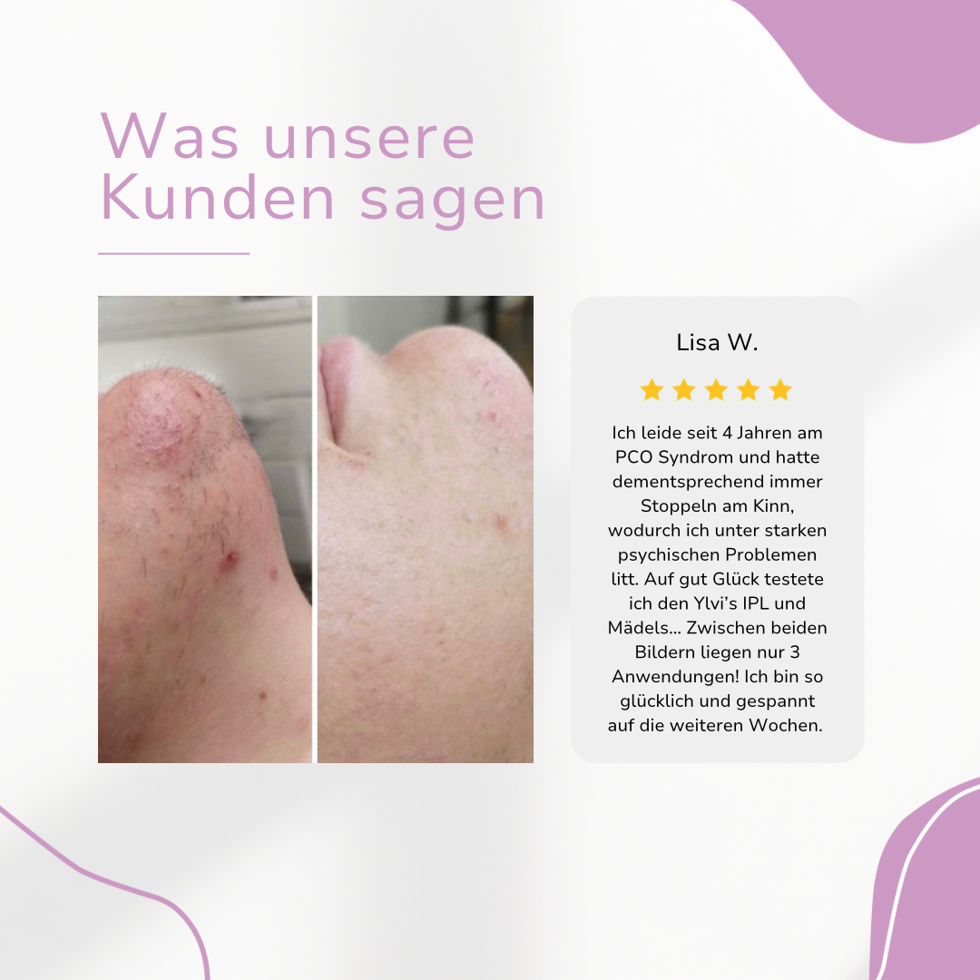 MILONDA Hair Remover - Deine schmerzfreie Revolution für seidig glatte Haut!