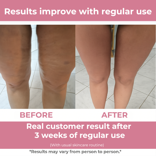 CelluSmooth – Enthüllen Sie glattere Haut und straffere Konturen.