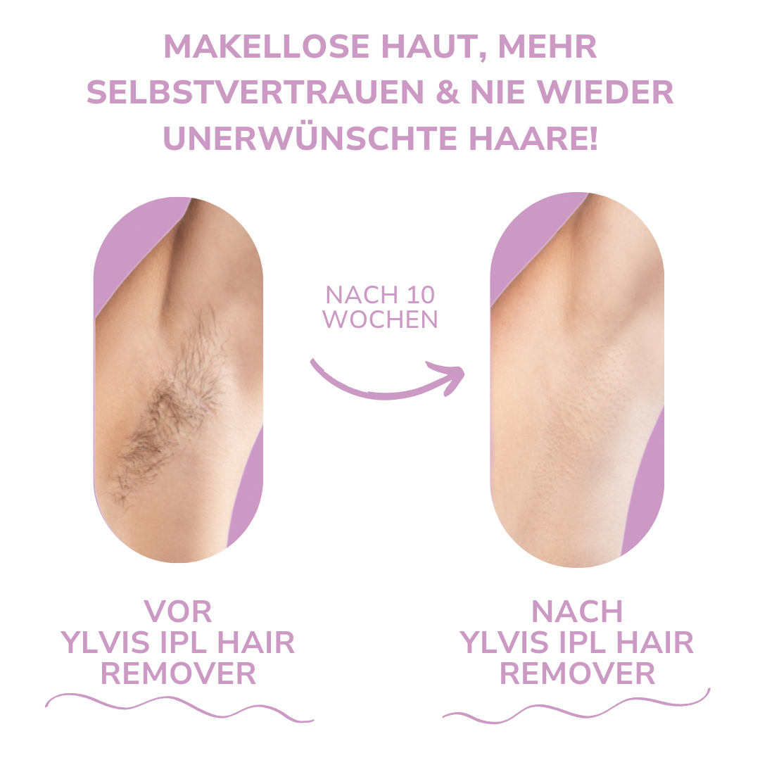 MILONDA Hair Remover - Deine schmerzfreie Revolution für seidig glatte Haut!