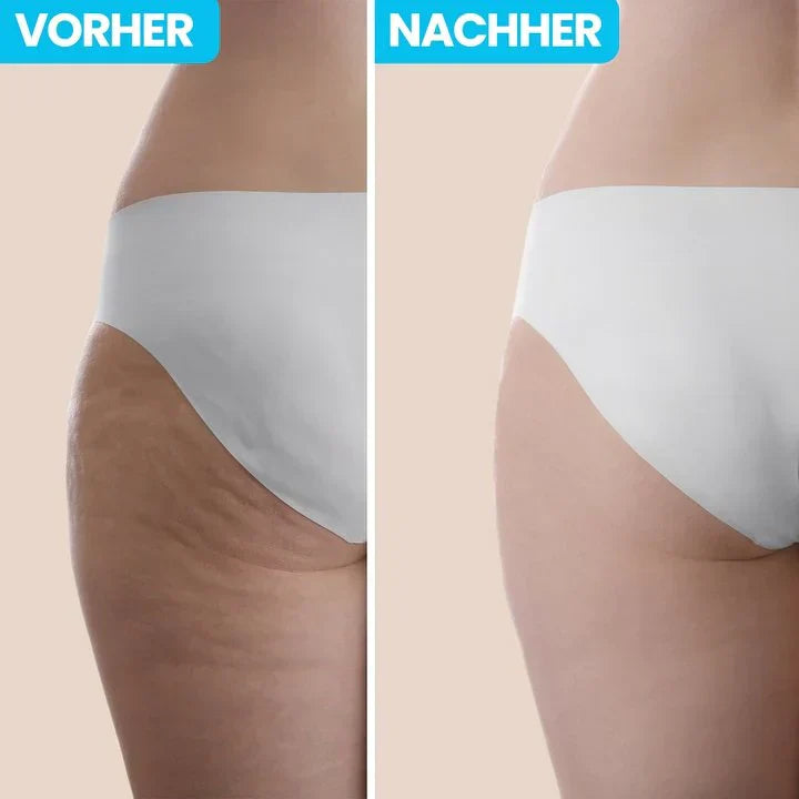CelluGlatt™ Gerät - Deine Waffe gegen Cellulite: Glatte Haut, die begeistert!
