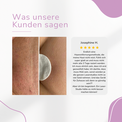MILONDA Hair Remover - Deine schmerzfreie Revolution für seidig glatte Haut!